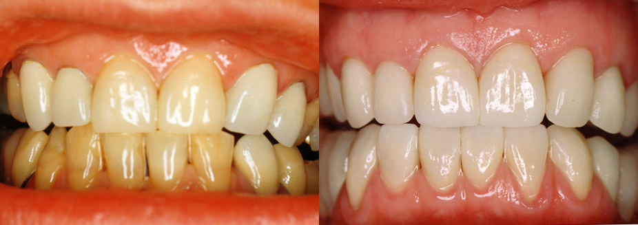 Veneers<br />
Give yourself a brighter, healthier smile. Front teeth that are stained, cracked, chipped or have unsightly spaces between them can look as good as new with laminate veneers. Veneers are a thin, translucent coating made out of porcelain or resin (plastic). They are applied to the front teeth to improve their colour, size, or shape. Veneers can help you achieve the smile you want.