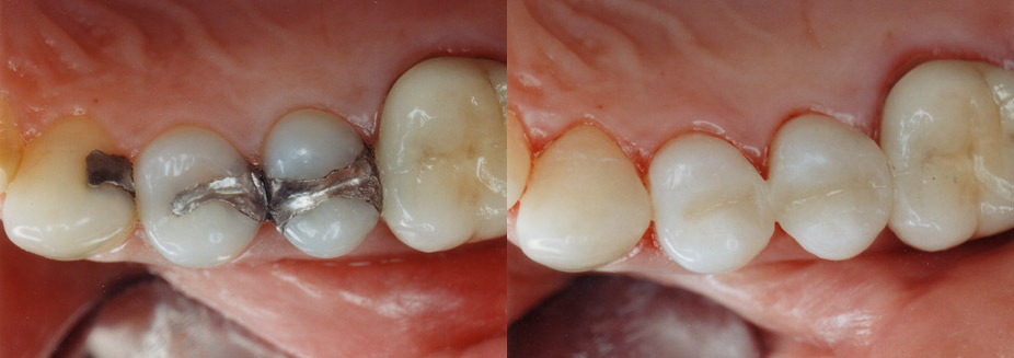 Tooth Coloured Inlays & Onlays<br />
Silver coloured amalgam fillings can now be replaced with attractive, strong tooth coloured inlays/onlays. Almost impossible to distinguish from the natural tooth, they virtually disappear when placed in the mouth.