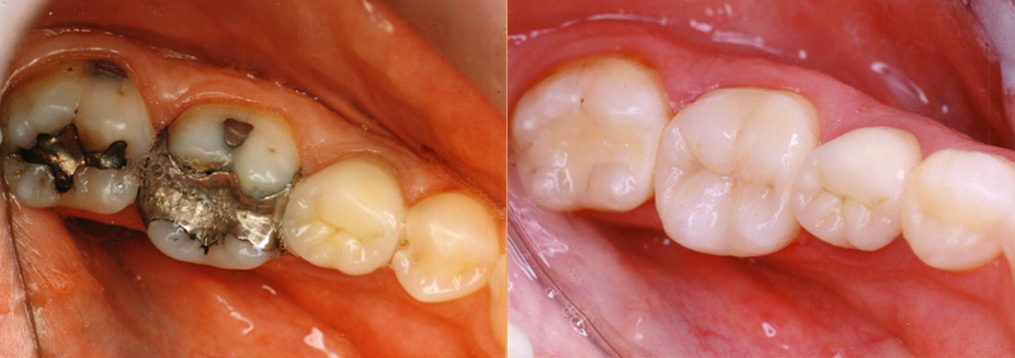 Crowns<br />
A crown, sometimes refrerred to as a 'cap', is an artificial covering cemented over an existing tooth that has been specially prepared by your dentist (somewhat like a thimble over your finger). Your dentist may recommend a crown if your tooth is fractured, has a large, old filling or is severely damaged by decay. Crowns can restore a tooth to its original shape, strengthen a tooth and improve your overall appearance.
<br />
Crowning is a long-term restorative procedure that can usuall be completed in two appointmnets. Crowns are designed to look and feel like your natural teeth.