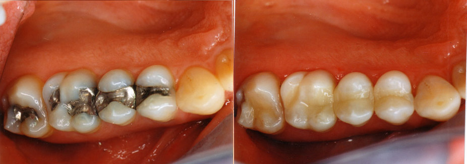 
Cosmetic Services<br />
Cosmetic services range from changing the look of an existing tooth to replacing an entire set of teeth. Cosmetics services are more affordable than ever before.
<br />
With the technology available today, cosmetic dentistry can make the most of your smile.
